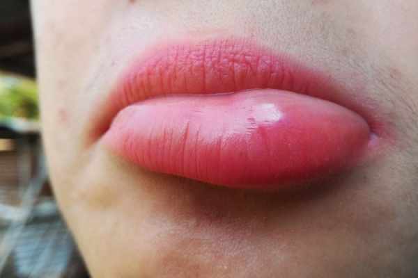 4 Penyebab Bibir yang Tiba Tiba Bengkak