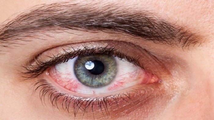 Apakah Mata Kering Dapat Menyebabkan Mata Negatif?